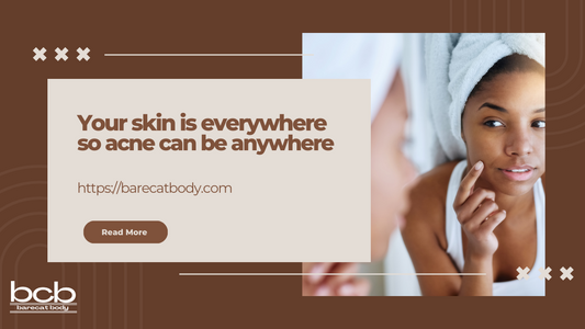 Your skin is everywhere on your body, so acne can be where ever your skin is